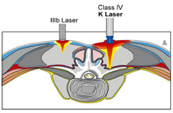 K Laser Therapy